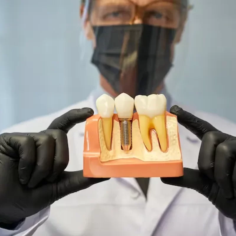 implantes dentales para adultos